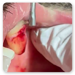 Wisdom Hook Dental Extraction Instrument in use during tooth removal procedure with rotating lug and diamond coated working end