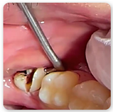 Wisdom Hook Dental Extraction Instrument in use during molar extraction procedure with rotating lug and diamond coated tip